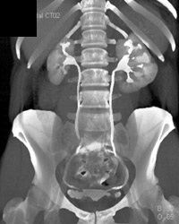 Ct Urogram- Chronic Pyelonephritis - CTisus CT Scan