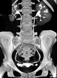 Dilated Calyces Due to Chronic Pyelonephritis - CTisus CT Scan