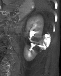 Renal Laceration With Contrast Extravasation - CTisus CT Scan