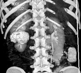 Extravasation Post Trauma in 3D - CTisus CT Scan