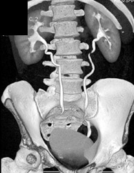 Normal CT Urogram - CTisus CT Scan
