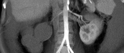 Hydronephrotic Sac for A Right Kidney - CTisus CT Scan