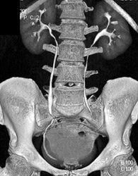 Normal CT Urogram - CTisus CT Scan