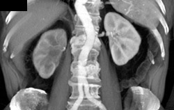 Dilated Right Ureter and Pelvis With Thickened Distal Right Ureter - CTisus CT Scan