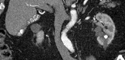 Renal Calculi - CTisus CT Scan