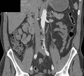 Normal CT Urogram - CTisus CT Scan