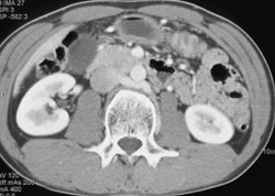 Retroaortic Left Renal Vein - CTisus CT Scan