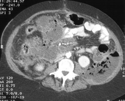 Infection in Left Posterior Pararenal Space - CTisus CT Scan
