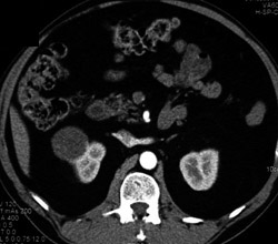 Renal Cyst - CTisus CT Scan