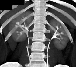Normal CT Urogram - CTisus CT Scan