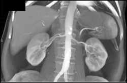 Prehilar Branching on the Right Renal Aa - CTisus CT Scan