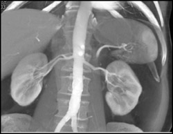 Prehilar Renal Aa Branching (VRT/MIP) - CTisus CT Scan
