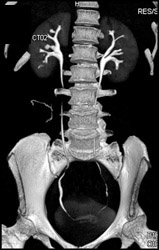 Normal CT Urogram - CTisus CT Scan