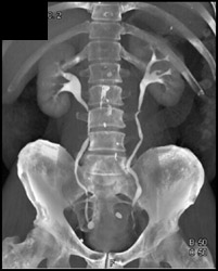 Normal CT Urogram - CTisus CT Scan
