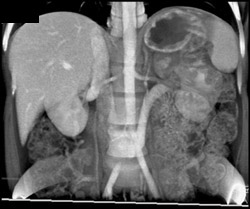 Retroaortic Left Renal Vein - CTisus CT Scan