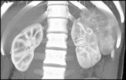 Cortical-medullary Phase of CT Study With Subtle Right Renal Mass - CTisus CT Scan