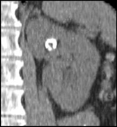 Renal Artery Aneurysm - CTisus CT Scan