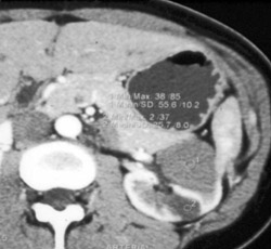 High Density Renal Cyst - CTisus CT Scan