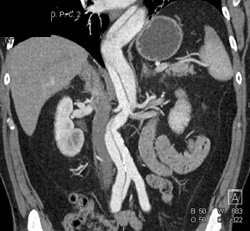 Decreased Function in Left Kidney - CTisus CT Scan