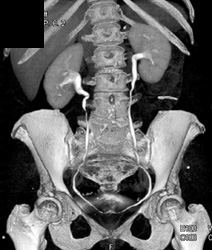 Normal CT Urogram - CTisus CT Scan