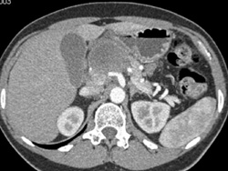 Metastatic Melanoma - CTisus CT Scan