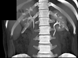 Normal CT Urogram - CTisus CT Scan
