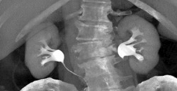 Normal CT Urogram - CTisus CT Scan