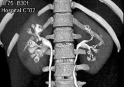 Medullary Sponge Kidney - CTisus CT Scan