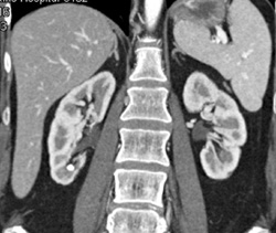 Stone in Lower Pole of Right Kidney - CTisus CT Scan