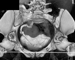 Ct Urogram of Distal Ureter - CTisus CT Scan