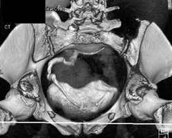 Ct of Distal Ureter - CTisus CT Scan