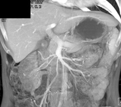 Unusual Collaterals Around the Right Kidney - CTisus CT Scan