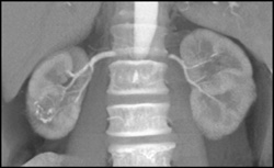 Calcified Rim to Renal Lesion - CTisus CT Scan