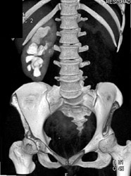 Hydronephrosis - CTisus CT Scan
