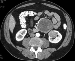 Metastatic Melanoma to Kidney and Mesentery - CTisus CT Scan