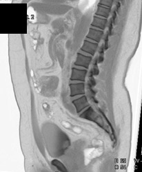 Bladder Cancer - CTisus CT Scan