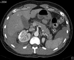 Renal Contusion and Laceration - CTisus CT Scan