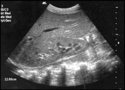Emphysematous Pyelonephritis- Ultrasound - CTisus CT Scan