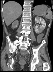 Infarction of Left Kidney - CTisus CT Scan