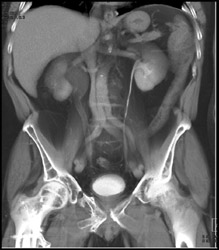 Ct Urogram With Tumor in Right Distal Ureter - CTisus CT Scan