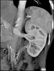 Circumaortic Right Renal Vein - CTisus CT Scan