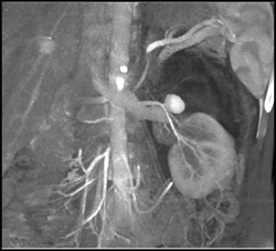 VRT of Pseudoaneurysm - CTisus CT Scan