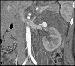 Pseudoaneurysm - CTisus CT Scan