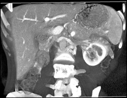 Retroaortic Renal Vein - CTisus CT Scan