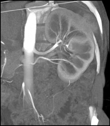 Normal Renal Arteries on A 16 Slice System - CTisus CT Scan