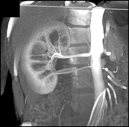 Normal Renal Arteries and Venous Anatomy - CTisus CT Scan
