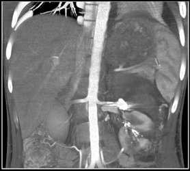 Embolized Renal Artery Aneurysm - CTisus CT Scan