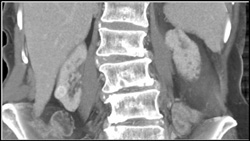 High Density Renal Cyst on the Right - CTisus CT Scan