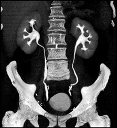 Normal CT Urogram - CTisus CT Scan