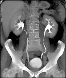Normal CT Urogram - CTisus CT Scan